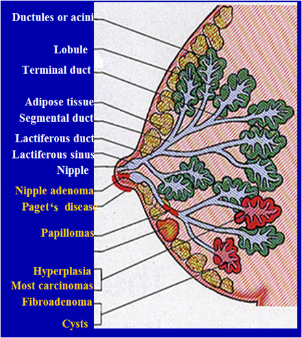 Breast cancer diagram.